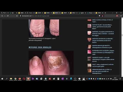 MYCOSE : pourquoi? que faire? doc dermato explique la mycose