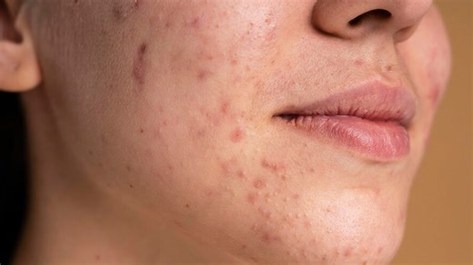 Clove Oil For Clear Skin: Here's How Clove Oil Helps In Treating Acne and Dark Spots