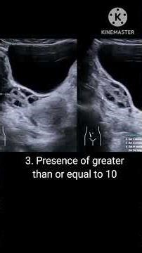 Polycystic ovarian morphology on ultrasound #ultrasound