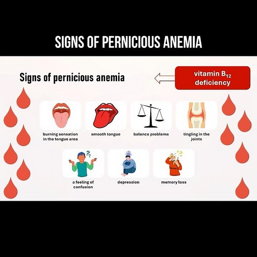 Signs of pernicious anemia #blooddisorders #anemia #anemiasymptoms #perniciousanemia