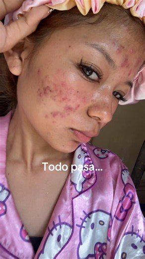 Antes y después del acné 🥺#acne #antesydespues #acneskin | acne scars