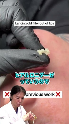 【ヒアルロン酸っぽい何か】唇からムニュッと絞り出す！従来のヒアルロン酸の摘出と異なる処置にたかし先生も疑問視！