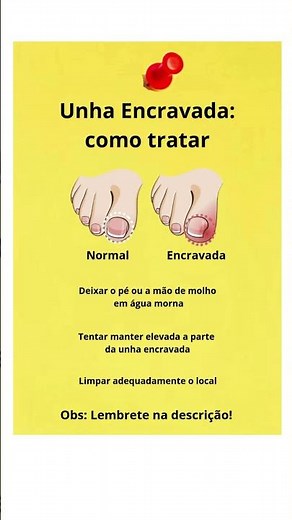 Unha encravada, saiba o que fazer! 📌Lembrete na descrição!