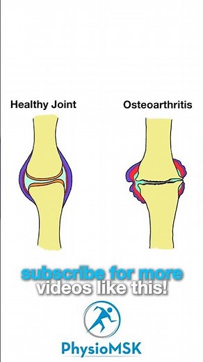 What is Osteoarthritis?