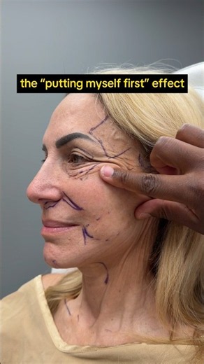 Aging Gracefully with a Facelift? 🤔 #facialplasticsurgery
