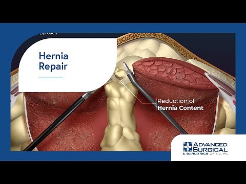 Hernia Repair 3D Animation