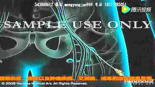 冠状动脉造影术心脏支架手术PCI手术3D动画