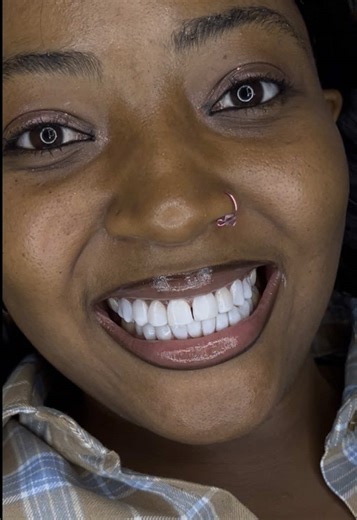 💵 PRICE: N1,200,000 (NAIRA) 🦷COMPOSITE VENEER (10 TOP, 10 BOTTOM) 🦷 NO SHAVING ⏰ TIME: 3-4 HOURS 📍LOCATION: ABUJA (TRAVEL PACKAGE AVAILABLE ✈️) 😎 RESULT: CELEBRITY SMILE 😃 🦷OUR VENEER ARE: ✔️DESIGNED TO FIT YOUR FACE ✔️NATURAL-LOOKING, ✔️NOT BULKY. ✔️INSTANT CONFIDENCE BOOST ✔️ DONE BY PROFESSIONALS WHO CARE ABOUT PERFECTION. 🦷YOUR SMILE IS THE FIRST THING PEOPLE NOTICE. MAKE IT UNFORGETTABLE. 📩BOOKINGS NOW OPEN DM