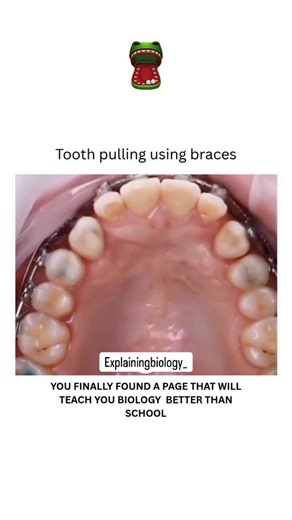 BIOLOGY | MEDICAL | HEALTH on Instagram: "Tooth extraction before or during braces treatment may be recommended for severe dental crowding to create space for proper alignment and achieve a healthy bite, though it is not necessary for all cases and is a safe procedure performed by an orthodontist removal of teeth, most common premolars, allows remaining teeth to shift into their correct positions, potentially leading to faster treatment and a balanced facial profile. However, the decision for to