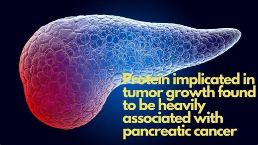 Protein implicated in tumor growth found to be heavily associated with pancreatic cancer | Dr. Robert Ryan