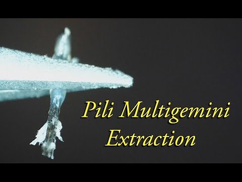 Extracting multiple hairs from one follicle (Pili Multigemini) - Close Up