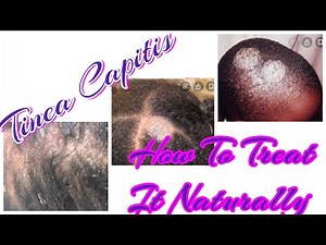 Tinea Capitis: How To Treat It Naturally (Diagnosed/update/treatment)