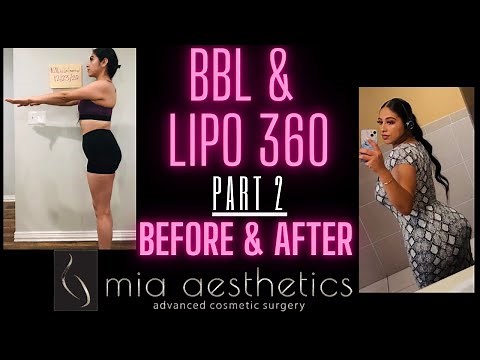 I GOT A BBL: PART 2 | MIA AESTHETICS | AUSTIN TX | DR. CHAREPOO | BEFORE AND AFTER