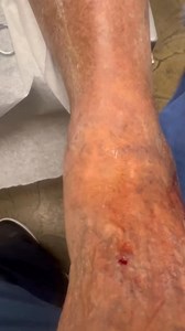I saw another patient in the office who bled from a vein on the foot. #bleeding from #footveins #feet | Vein Treatment Center