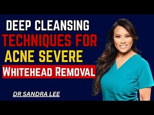 Deep Cleansing Techniques For Acne — Severe Whitehead Removal.[DR SANDRA LEE]