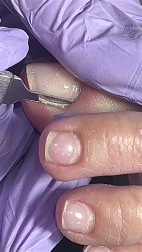 เป็นการตัดเล็บขบที่ลูกค้าร้องเสียงเซ็กซี่มาก☺️ ช่างก็พยายามเบามือมากๆค่ะ #ตัดเล็บขบอยุธยา #ร้านทำเล็บห้างเดอะสกาย #ตัดเล็บขบห้างเดอะสกาย #ตัดเล็บขบใกล้ฉัน #ร้านทำเล็บห้างเดอะสกาย