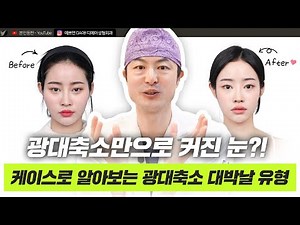 광대축소술 하면 대박 나는 얼굴은? 얼굴 여백 줄이고 이목구비 키우는 옆광대 45도 광대축소 3D CT 케이스 리뷰 (디에이성형외과)