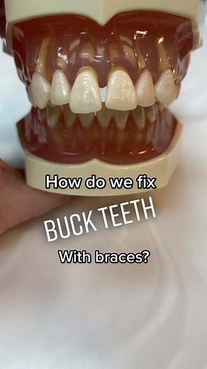 Fixing Buck Teeth with Braces: A Comprehensive Guide