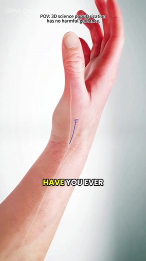 Tendon Replacement for Trapezium Bone in Thumb Arthritis