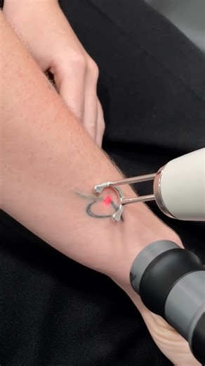 Tampa Bay Tattoo Removal | Laser Tattoo Removal | Clearwater FL on Instagram: "Thinking about removing a tattoo? 🤔 Here are the most common questions we get at Tampa Bay Tattoo Removal: ❓ Does laser tattoo removal hurt? Most clients describe it as a quick rubber band snap to the skin; although it may be uncomfortable, it takes a matter of seconds to minutes for most Tattoo Removal sessions. ❓ What is the “snowing effect”? That white, frosty look immediately after the laser hits the ink is calle