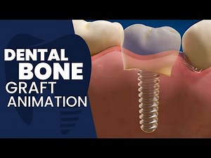 Dental Bone Graft Animation
