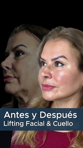 Antes y después de Lifting Facial y de Cuello #facelift #liftingfacial | Dr. Marcelo Ponce
