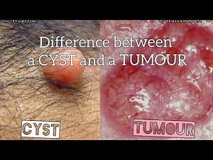 CYST VS. TUMOUR : WHAT'S THE DIFFERENCE?