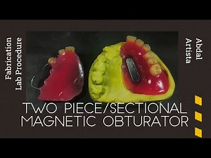 Fabrication: Two Piece/Sectional Magnetic Obturator | Prosthodontic Rehabilitation, Hemimaxillectomy