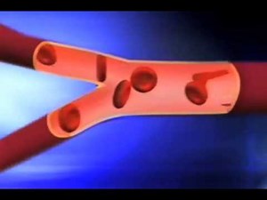 What are the effects of Sickle Cell Disease?