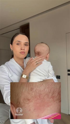 Andreea Domnițeanu on Instagram: "Dacă ai observat pete roz pe fața sau ceafa bebelușului tău, respiră. Cel mai probabil este naevus simplex. O modificare vasculară benignă, extrem de frecventă la nou-născuți, prezentă de la naștere. Nu doare, nu mănâncă, nu este periculoasă și nu necesită tratament. De cele mai multe ori: • se estompează treptat în primii ani • devine mai vizibilă când bebe plânge sau se înroșește • nu influențează dezvoltarea copilului Ca dermatolog, îți spun: nu tot ce arată