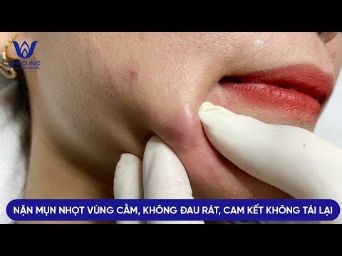 TREATING ACNE (ABSCIS) IN THE CHIN AREA, COMMITMENT TO 1 TIME EFFECTIVE TREATMENT, NO RECURRENCE ...