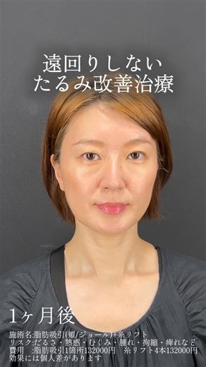 TIAM CLINIC GINZA副院長 森 紳之介 on Instagram: "脂肪吸引と糸リフトでここまで変わります✨ ▶︎小顔脂肪吸引 1箇所8チケット（88,000〜132,000円） 💥リスク 腫れ、内出血、左右差、感染症、神経傷害など 激しい運動は1週間お控えいただきます 🌳予約は全てプロフィールTOP URLより【森指名】でお問い合わせください まずはカウンセリングでお待ちしております ▶︎ @dr_s.mori ◆─────────────────────────◆ ⁡ ⁡📍TIAM CLINIC GINZA （ティアムクリニック銀座） ☎︎ 03-6280-6007 〒104-0061 東京都中央区銀座7-3-7 ブランエスパ銀座13階 ⏰10:00～19:00 ⁡ ◆─────────────────────────◆"