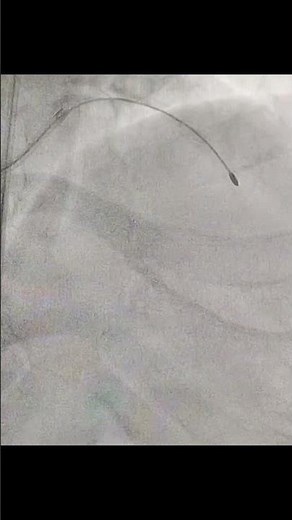 Pecking motion of burr in Rotational atherectomy Rotapro.