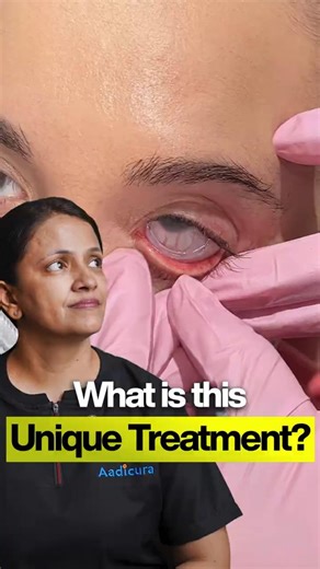 Cornea Ko Bachane Ka Naya Tarika 😱 Prokera Kya Hai? | Eye Doctor Explains