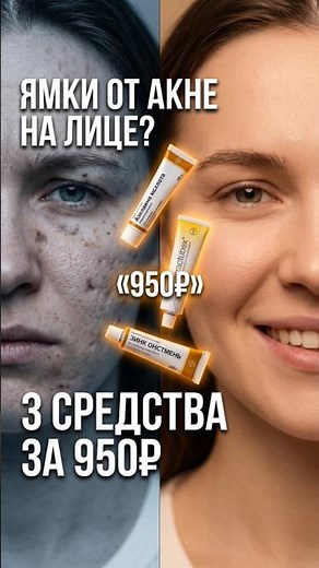 Acne pits on the face - azelaic acid, Contractubex, zinc ointment for 950 rubles.