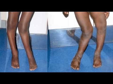 Windswept Deformity in Children; leg shows genu valgum knock knee and genu varum bow leg