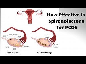 How Effective is Spironolactone for PCOS