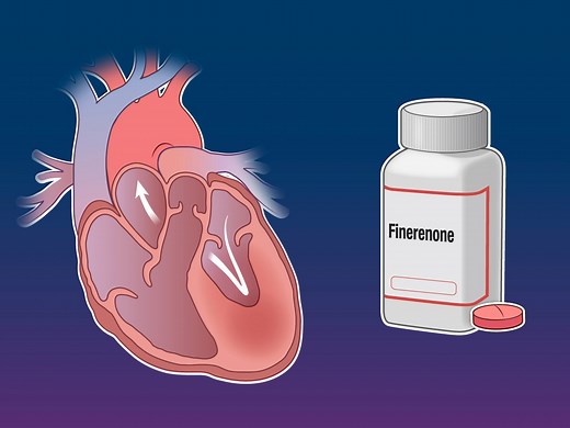 10K views · 70 reactions | Therapies are needed for patients with heart failure with mildly reduced or preserved ejection fraction. Research findings on the nonsteroidal mineralocorticoid receptor antagonist finerenone are summarized in a new Quick Take video. Link to research findings in comments. | The New England Journal of Medicine | Facebook