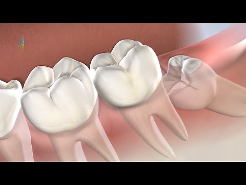 Post-Operative Instructions: Following Wisdom Tooth Removal | Oral Surgery Specialists of Oklahoma