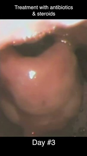 Epiglottitis Healing Time Lapse Over 7 Days in 20 Seconds #shorts ‪@fauquierent‬