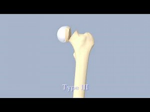 Hip Fractures