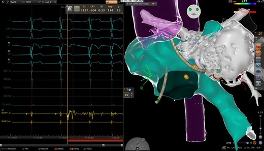 #avnrt #cctga #situs #inversus #dextrocardia #epeeps | Martina Nesti