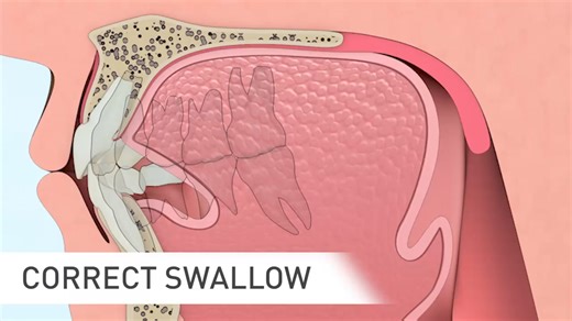 Malocclusion is a symptom of an underlying problem, not the problem itself. Mouth breathing and swallowing incorrectly are examples of poor functional habits that restrict the growth of the jaws and limit space, causing the teeth to crowd. | Myofunctional Research Co.