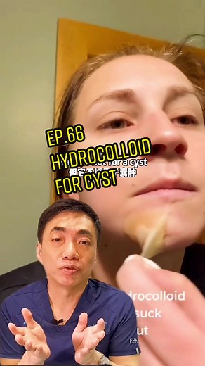 Hydrocolloid Patch for Cyst: Effective Skincare Solution