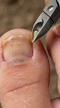 Deep Toenail Cleaning for Healthy Feet