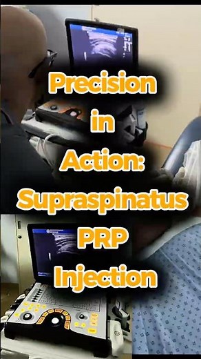 Chronic Shoulder Pain Fixed: Ultrasound-Guided PRP Injection for a Supraspinatus Tear