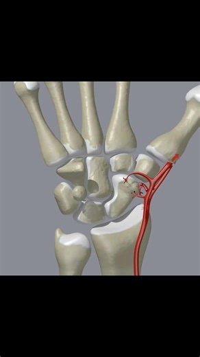 Scaphoid Fracture: Don’t Miss This Wrist Injury 🦴