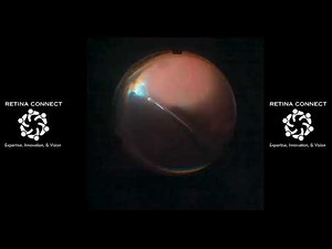 Retinal Detachment Surgery: Expert Guide to Managing a Fresh RD