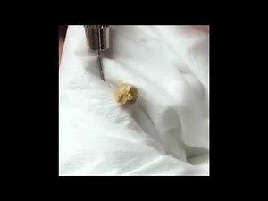 TikTok Pimple Popping Compilation #2 (Big Pimples and Massive Blackhead Extraction) MUST WATCH!!!