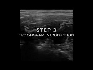 Ultrasound Guided Iliopsoas Tenotomy for Iliopsoas Tendon Impingement